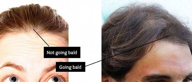 Toinen tapa estää kaljuuntuminen on olla lempeä päänahalle