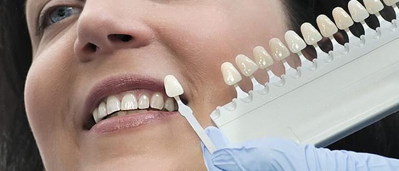 Hammasviilu voi saada hampaat näyttämään valkoisemmilta